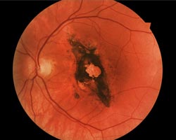 Diabetic patient retina image reference