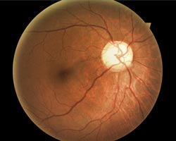 Optic disc retina image reference